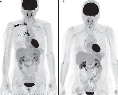 Vascular Acrosyndromes Associated With Prolonged Tumor Response in Advanced Lung Cancer Patients During Treatment With Antimetabolites: A Report of Two Cases